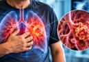 Lung Cancer: Risk Factors, Diagnostic Tests, and Treatment – India Times Group